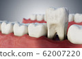 Infected tooth in mouth. 3D rendered illustration. 62007220