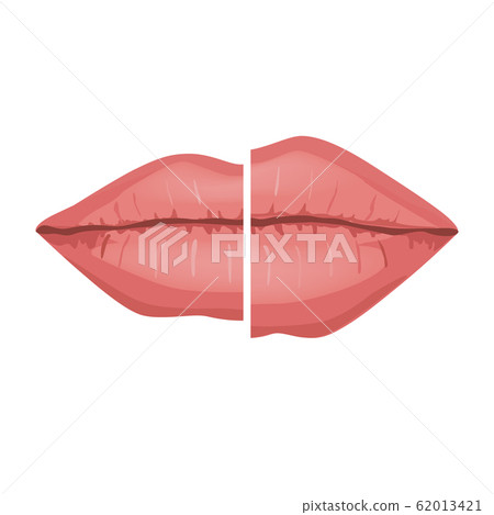 Female Lips Before and after Filler Injections, Vector Infographic illustration. Beautiful and Sexy Perfect Lips Isolated on White background Female Lips Before and after Filler Injections, Vector Infographic illustration. Beautiful and Sexy Perfect Lips Isolated on White background 62013421