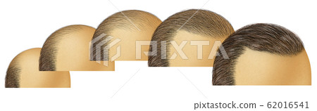 Bald Head Hair Growth 62016541