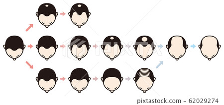 Hamilton Norwood Classification Bald 62029274