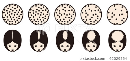 Ludwig's Classification Bald 62029364