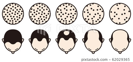 Hamilton Norwood Classification Bald 62029365