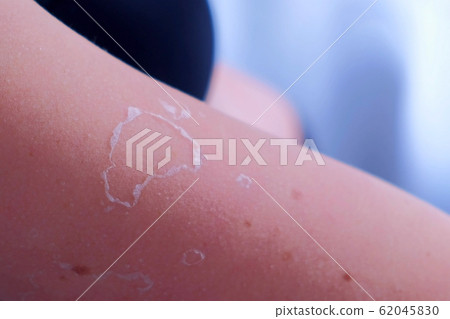 Woman with peeling skin from UV sunburn on legs and tummy, closeup. 62045830