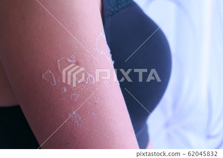 Woman with peeling skin from UV sunburn on shoulder, closeup. 62045832