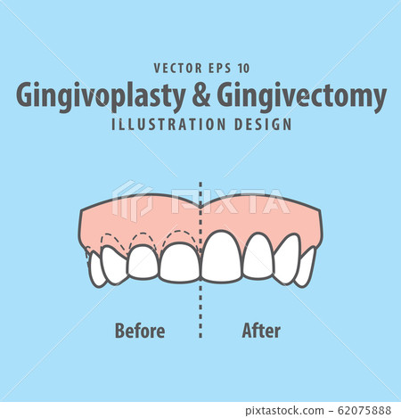 Compare upper teeth Gingivoplasty & Gingivectomy Compare upper teeth Gingivoplasty & Gingivectomy 62075888