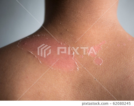 peeling skin at back and shoulder from sunburn effect on body of young man from sunbath at summer. dangerous sunburn concept 62080245