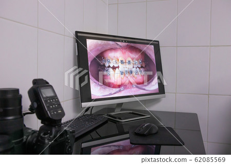 photograph of a jaw with braces on a computer 62085569