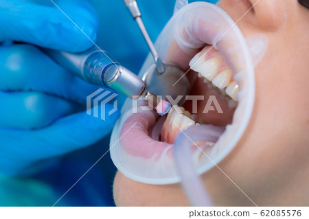 Close-up of a tooth drill with a head for 62085576