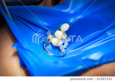 Close-up latex plate designed to isolate the tooth 62085582