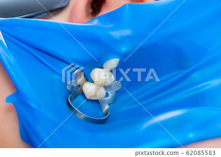 Close-up latex plate designed to isolate the tooth Close-up latex plate designed to isolate the tooth 62085583