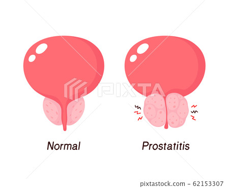 Normal prostate and benign prostatic hyperplasia 62153307