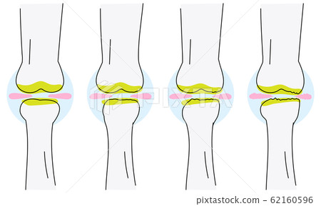半月板磨損在膝蓋骨關節炎矢量圖 插圖素材 62160596 Pixta圖庫