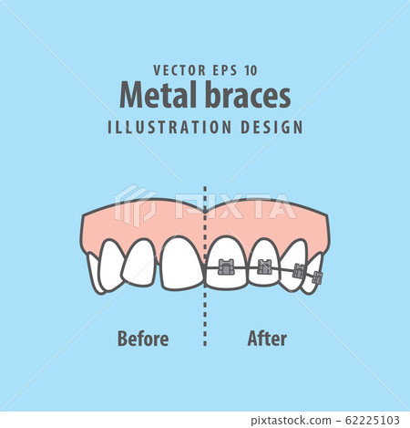 Compare upper teeth Metal braces before and after Compare upper teeth Metal braces before and after 62225103