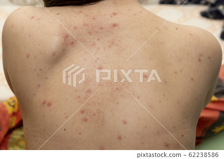 Upper back of young woman contracted chickenpox and red rash spilled on her skin 62238586