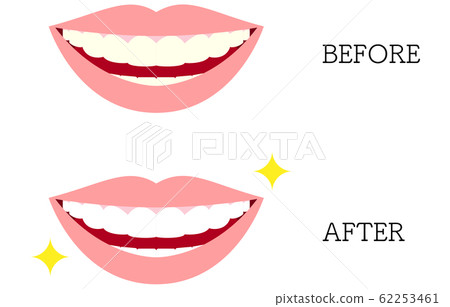 Aesthetic dentistry, illustration of yellowed teeth and white teeth 62253461