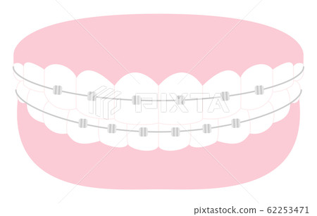 Illustration of esthetic dentistry and orthodontics: beautiful teeth arrangement and metal bracket 62253471