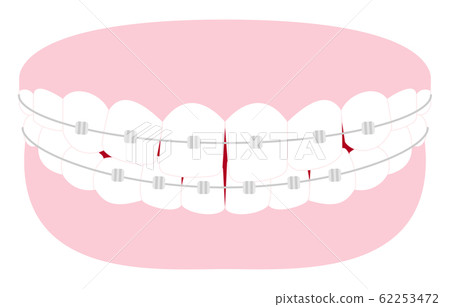 Illustration of esthetic dentistry and orthodontics: Distorted tooth arrangement and metal bracket 62253472