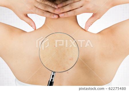 Acne on the back 62275480