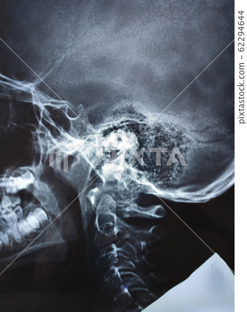 Adenoid hypertrophy Grade III in Xray Nasopharynx 62294644