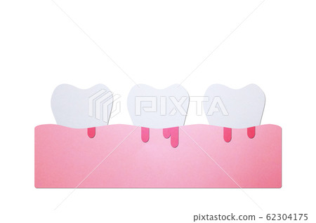 periodontitis or gum disease with bleeding ( blood flow come from gum and tooth ), dental problem 62304175