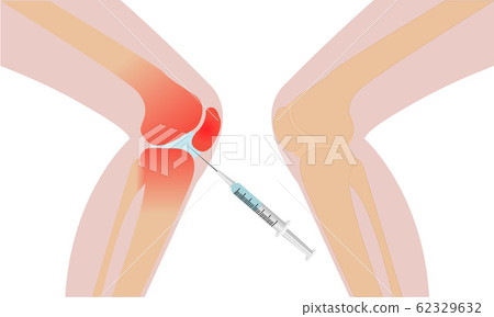 Knee injection inflammation redness recovery 62329632