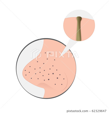 Blackheads on Nose 62329647