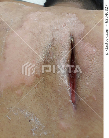 Surgical wound large abscess with surrounding cellulitis.  62340827