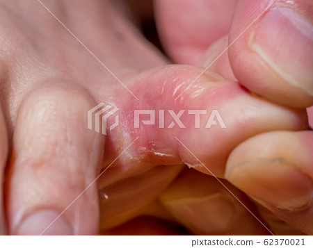 Athlete's foot with early symptoms Athlete's foot with early symptoms 62370021