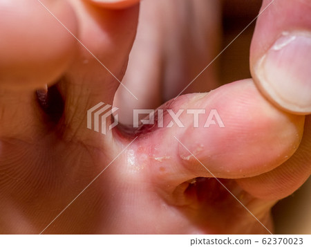 Athlete's foot with early symptoms 62370023