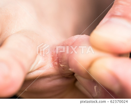 Athlete's foot with early symptoms 62370024