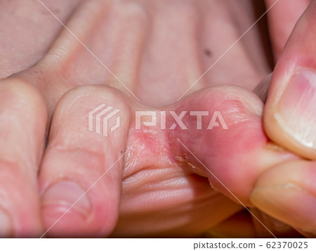 Athlete's foot with early symptoms 62370025