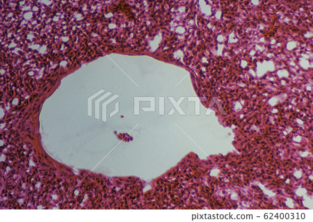 肺部顯微照片 62400310