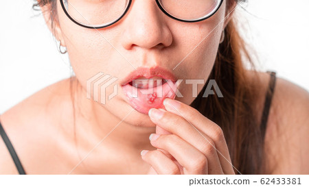 Asian women have aphthous ulcers on mouth on white Asian women have aphthous ulcers on mouth on white 62433381
