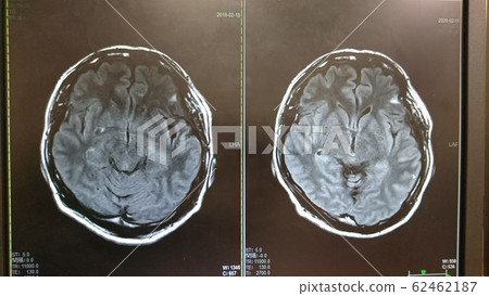 MR image of the brain resection of meningioma 2017.3 right 2019.2 left 2020.2 62462187