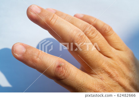 Woman peeled index finger and scar skin on hand, White background, Close up & Macro shot, Asian Body skin part, Healthcare concept Woman peeled index finger and scar skin on hand, White background, Close up & Macro shot, Asian Body skin part, Healthcare concept 62482666