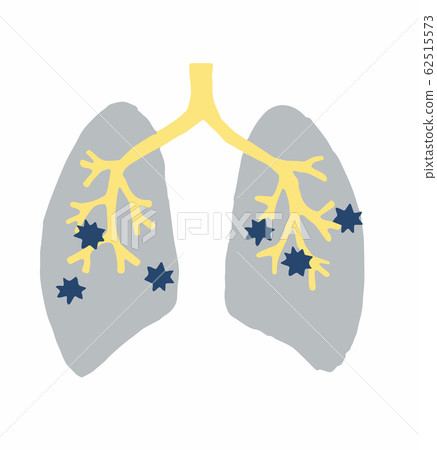 Pneumonia pulmonary tuberculosis 62515573