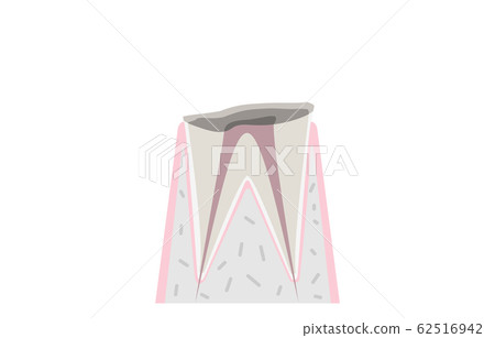 Progress of caries, only the root of the tooth remains with caries Progress of caries, only the root of the tooth remains with caries 62516942