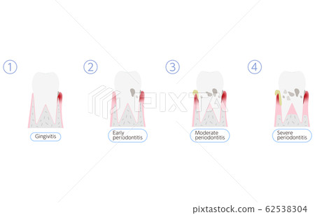 Periodontal disease progression illustration, 4 stages Periodontal disease progression illustration, 4 stages 62538304