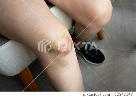 Woman with Bruise on knee from accident Woman with Bruise on knee from accident 62541147