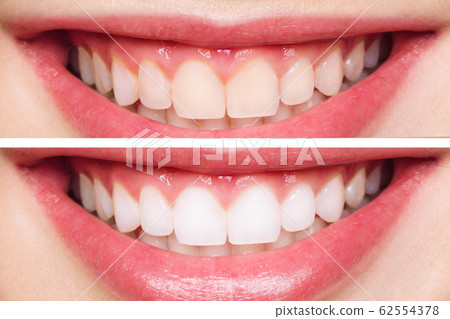 woman teeth before and after whitening. Over white background. Dental clinic patient. Image symbolizes oral care dentistry, stomatology 62554378