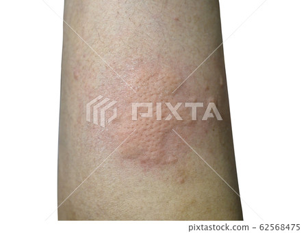 Swollen and inflamed skin from insect sting on Swollen and inflamed skin from insect sting on 62568475