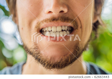 Man placing a bite plate in his mouth to protect his teeth at night from grinding caused by bruxism 62663443