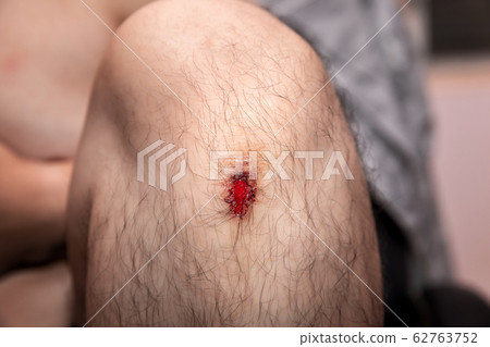 Closeup of fresh wound on man's knee from accident. 62763752