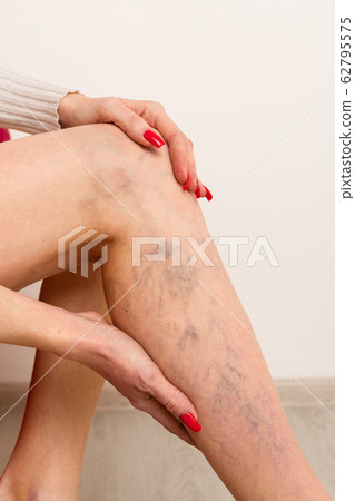 Painful varicose and spider veins on female legs. Painful varicose and spider veins on female legs. 62795575
