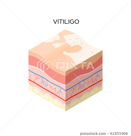 vitiligo skin cross-section of human skin layers structure skincare medical concept flat vitiligo skin cross-section of human skin layers structure skincare medical concept flat 62855906