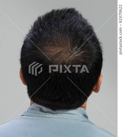 back view of male hair head part bald 62870622