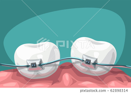 cartoon teeth with steel braces - Stock Illustration [62898314] - PIXTA