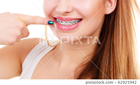 Woman showing her teeth with braces 62925942