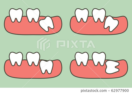 type of wisdom tooth affect to other teeth type of wisdom tooth affect to other teeth 62977900