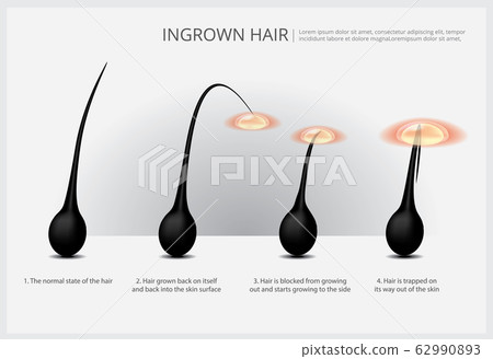 Hair Removal Example Vector Illustration 62990893